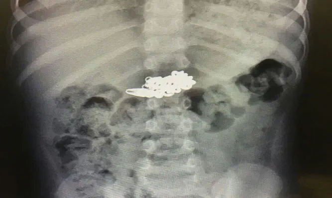 תמונת ההדמיה של השרשרת בקיבה