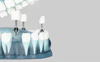 השלבים בהליך השתלת שיניים