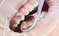 יישור שיניים באמצעות אינויזליין