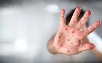 Measles case reported near Haifa