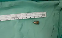 כדור תועה נתקע בצווארו של בן 5 מסוריה