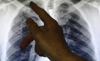 האם ניתן למנוע את התפשטות סרטן הריאות?