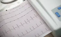 What is atrial fibrillation and how do you treat it?