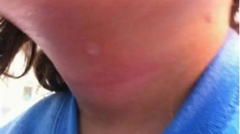 Marks on the toddler's neck.