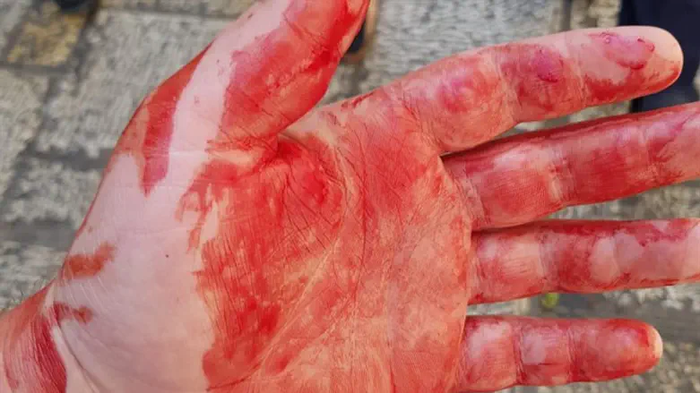Кровь на руках пострадавшего от нападения