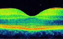 New Imaging Device in Tzfat Hospital Spots Eye Disease