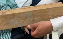 5-year-old hospitalized with wooden board attached to his hand