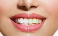 איך לשמור על שיניים לבנות?