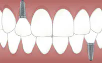 השתלת שיניים –מה חשוב לדעת על התהליך