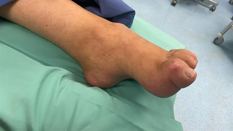 רגלו של יעיש כהן לפני הניתוח