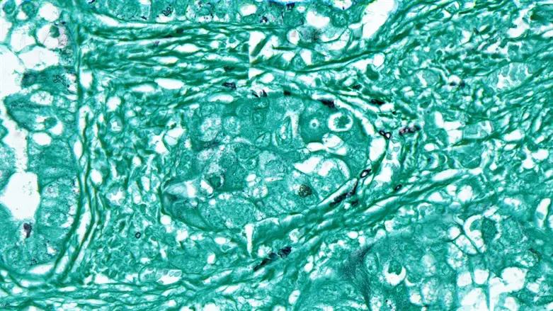 Fungi (black) present in human lung cancer tissue (turquoise) but not inside the cells.
